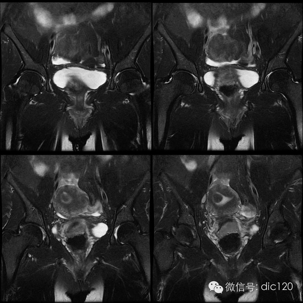 【病例学习】典型宫颈癌一例MR诊断与鉴别 【病例学习】典型宫颈癌一例MR诊断与鉴别