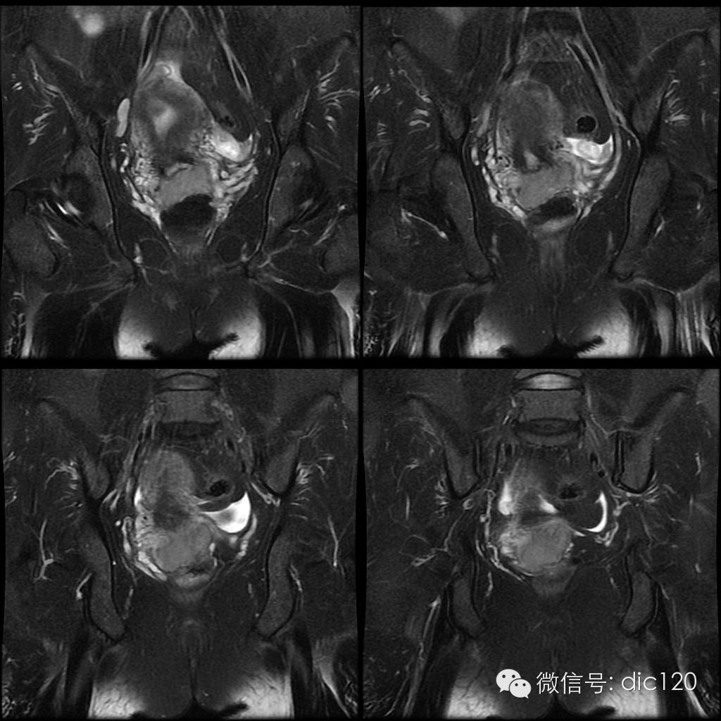 【病例学习】典型宫颈癌一例MR诊断与鉴别 【病例学习】典型宫颈癌一例MR诊断与鉴别