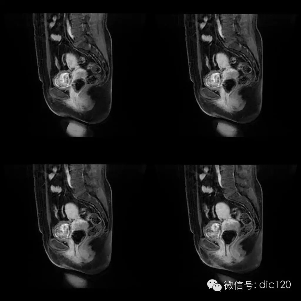 【病例学习】典型宫颈癌一例MR诊断与鉴别 【病例学习】典型宫颈癌一例MR诊断与鉴别