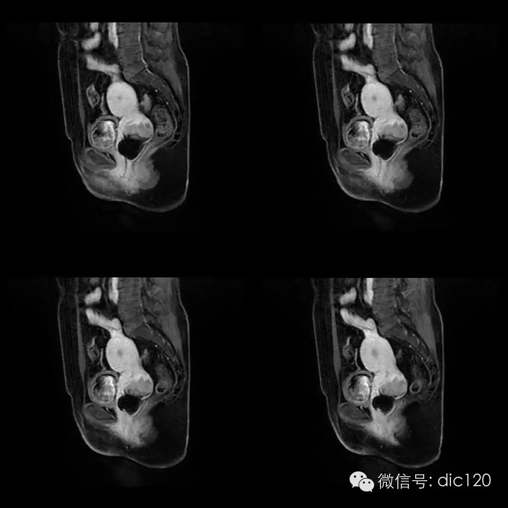 【病例学习】典型宫颈癌一例MR诊断与鉴别 【病例学习】典型宫颈癌一例MR诊断与鉴别