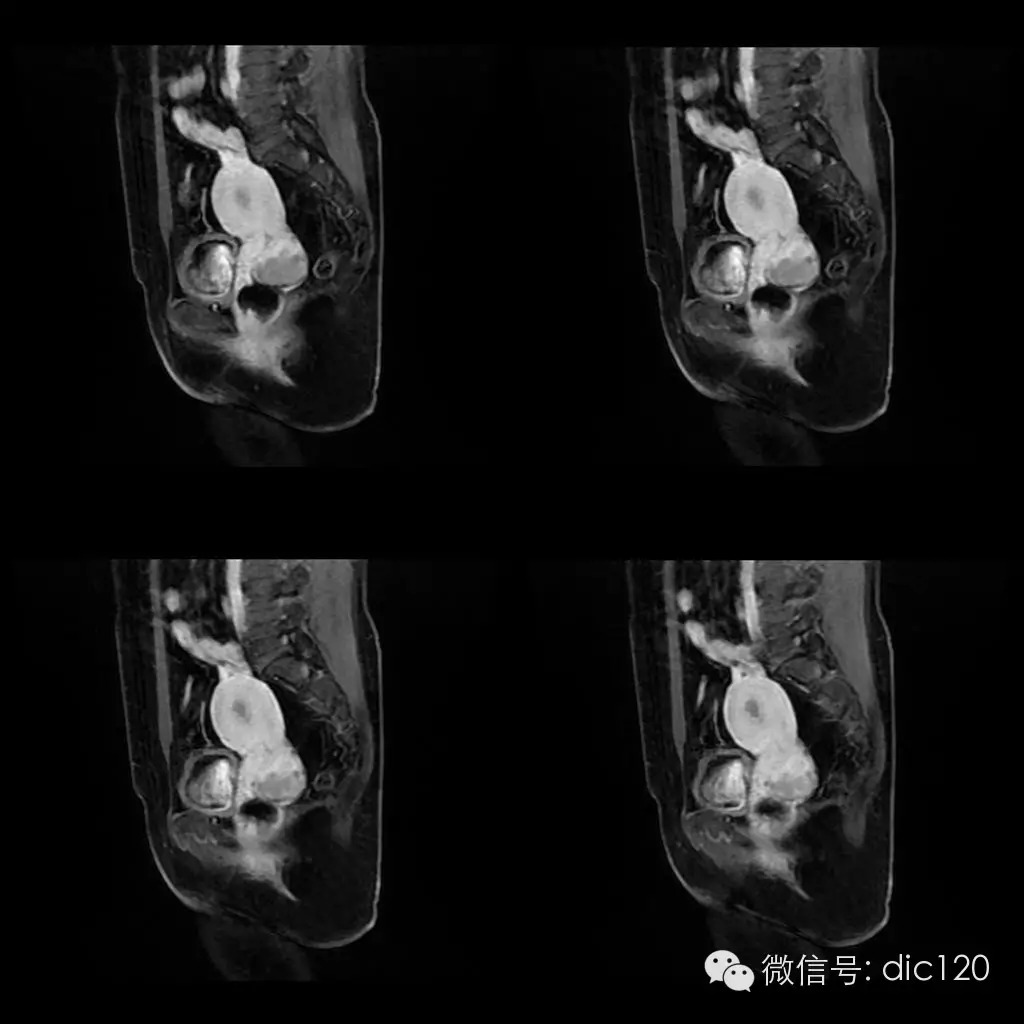 【病例学习】典型宫颈癌一例MR诊断与鉴别 【病例学习】典型宫颈癌一例MR诊断与鉴别