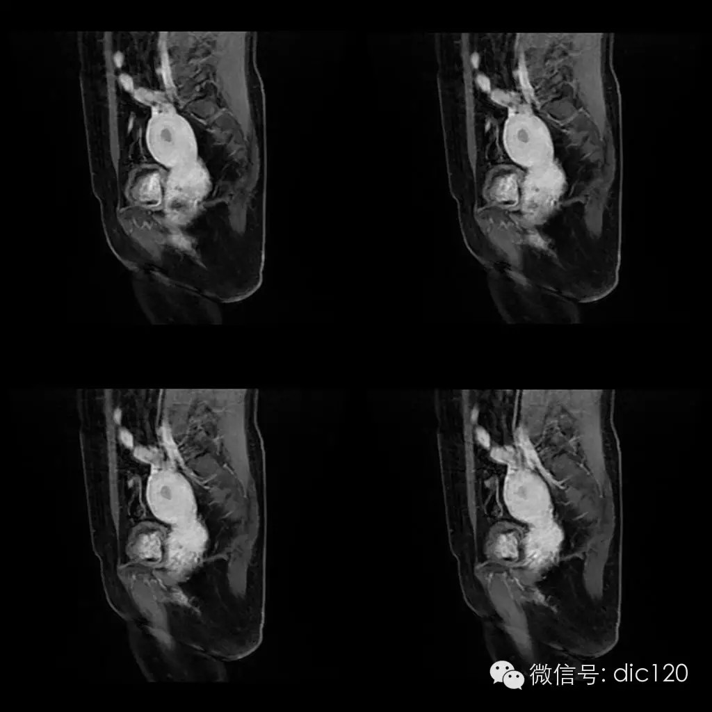 【病例学习】典型宫颈癌一例MR诊断与鉴别 【病例学习】典型宫颈癌一例MR诊断与鉴别
