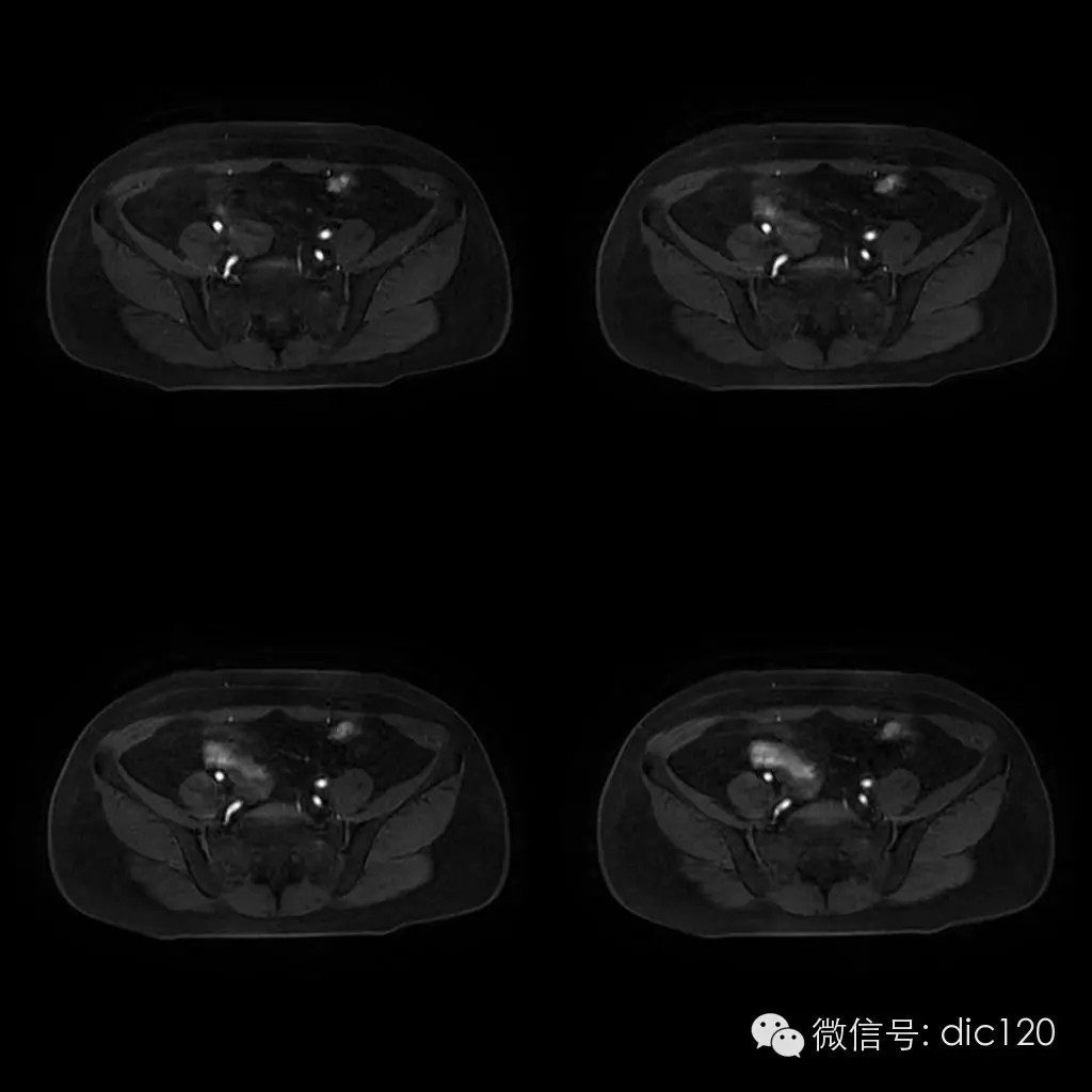 【病例学习】典型宫颈癌一例MR诊断与鉴别 【病例学习】典型宫颈癌一例MR诊断与鉴别