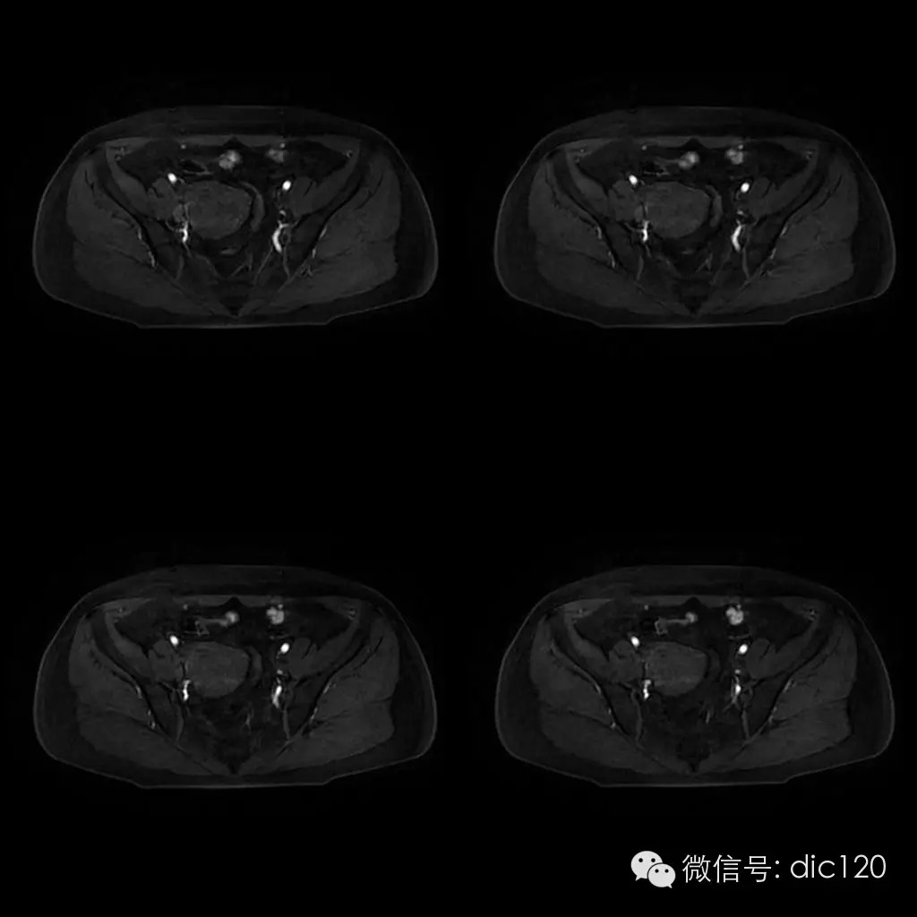 【病例学习】典型宫颈癌一例MR诊断与鉴别 【病例学习】典型宫颈癌一例MR诊断与鉴别