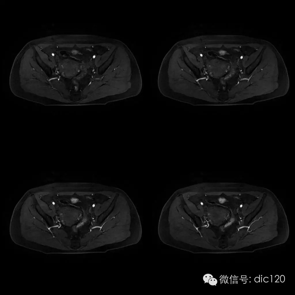 【病例学习】典型宫颈癌一例MR诊断与鉴别 【病例学习】典型宫颈癌一例MR诊断与鉴别