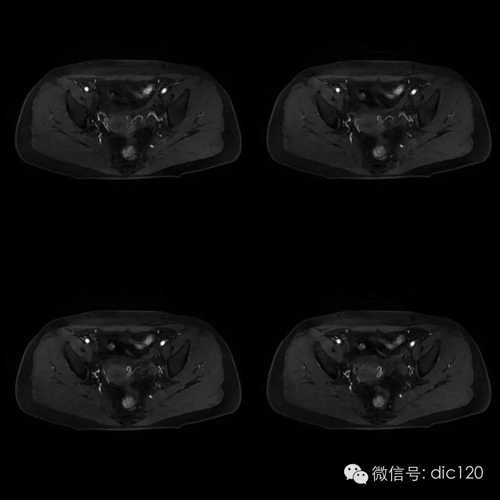 【病例学习】典型宫颈癌一例MR诊断与鉴别 【病例学习】典型宫颈癌一例MR诊断与鉴别