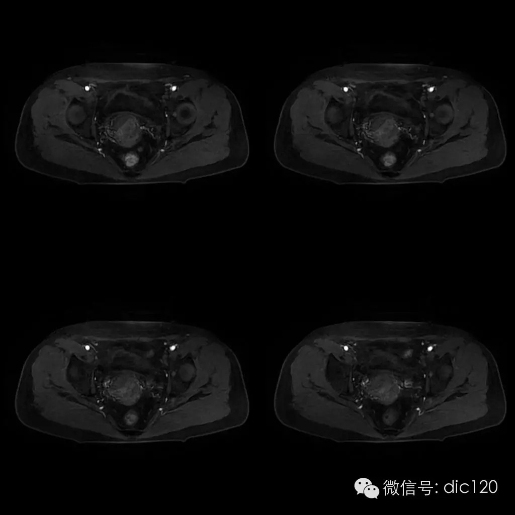 【病例学习】典型宫颈癌一例MR诊断与鉴别 【病例学习】典型宫颈癌一例MR诊断与鉴别