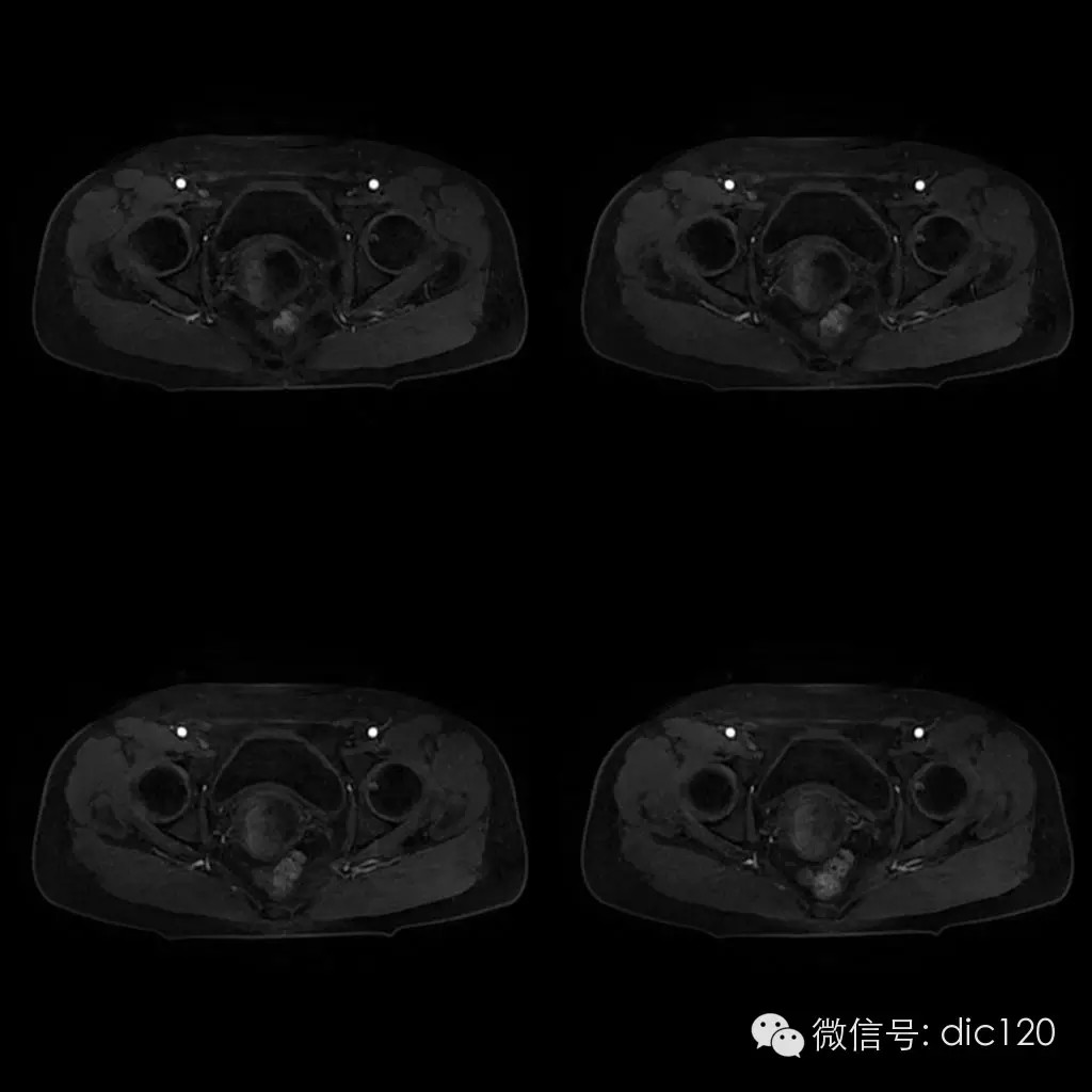 【病例学习】典型宫颈癌一例MR诊断与鉴别 【病例学习】典型宫颈癌一例MR诊断与鉴别