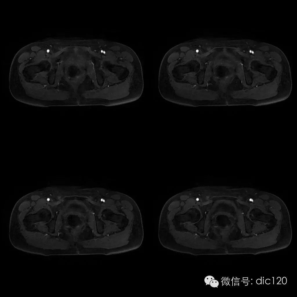 【病例学习】典型宫颈癌一例MR诊断与鉴别 【病例学习】典型宫颈癌一例MR诊断与鉴别