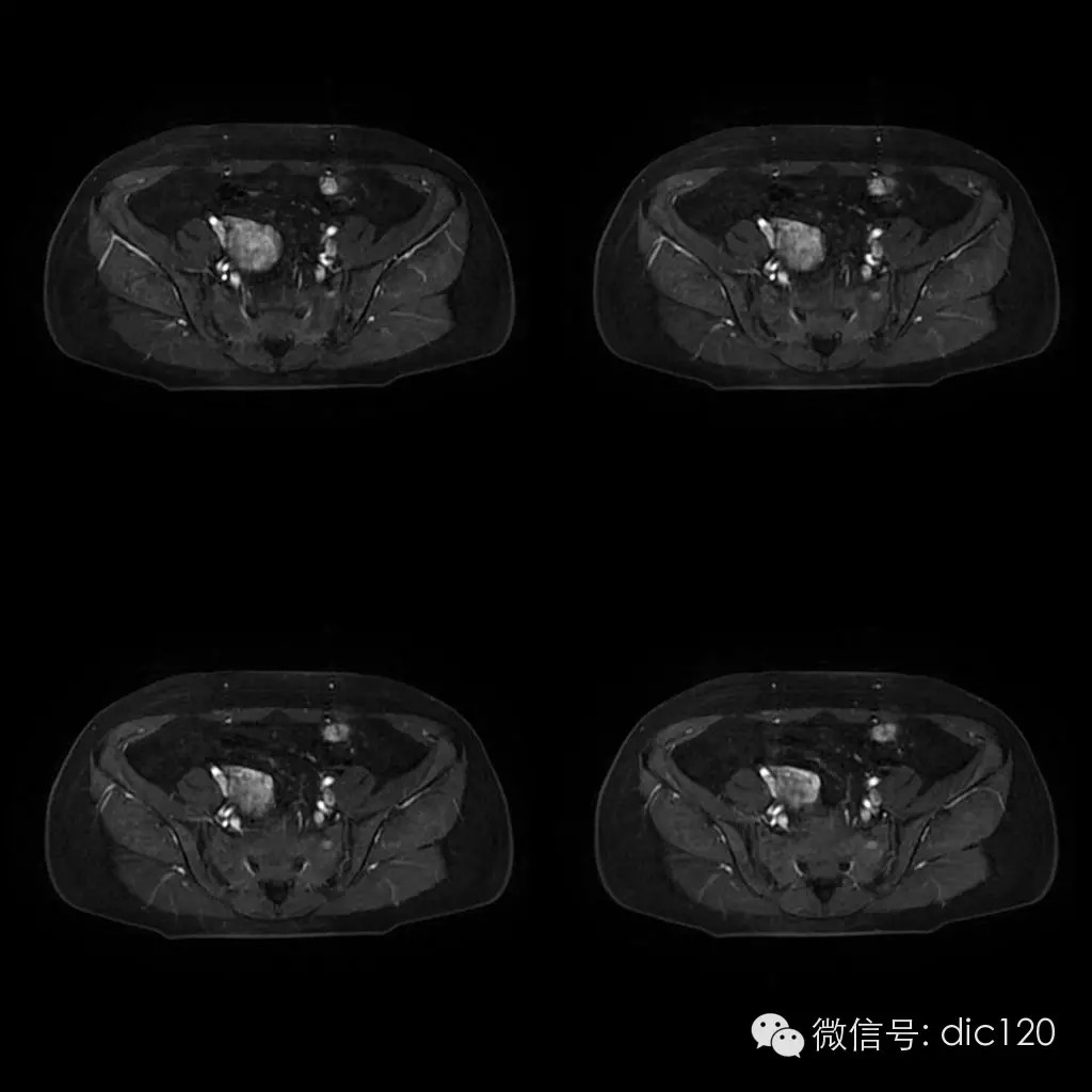 【病例学习】典型宫颈癌一例MR诊断与鉴别 【病例学习】典型宫颈癌一例MR诊断与鉴别