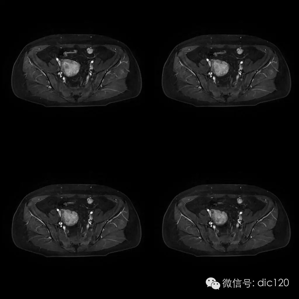 【病例学习】典型宫颈癌一例MR诊断与鉴别 【病例学习】典型宫颈癌一例MR诊断与鉴别
