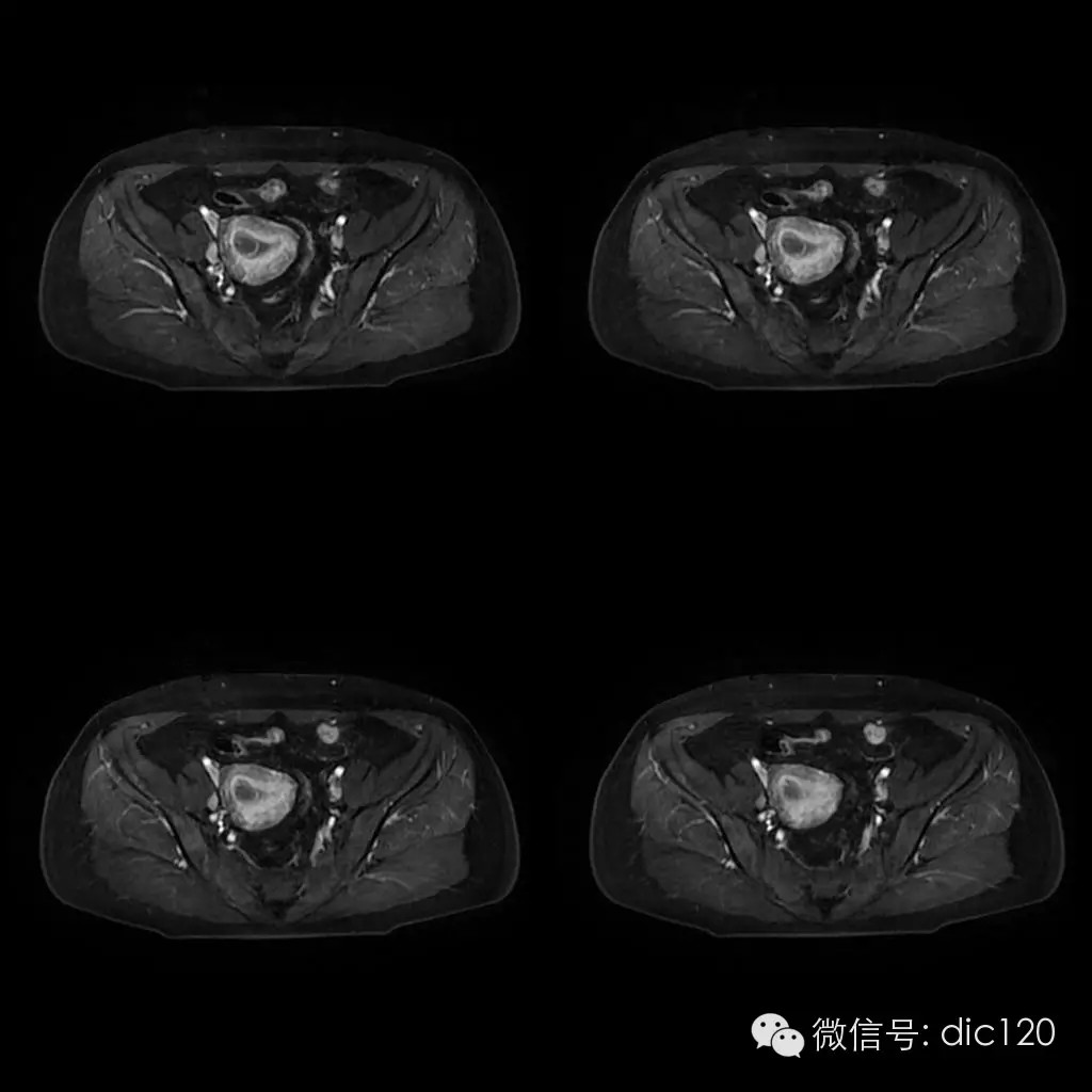 【病例学习】典型宫颈癌一例MR诊断与鉴别 【病例学习】典型宫颈癌一例MR诊断与鉴别