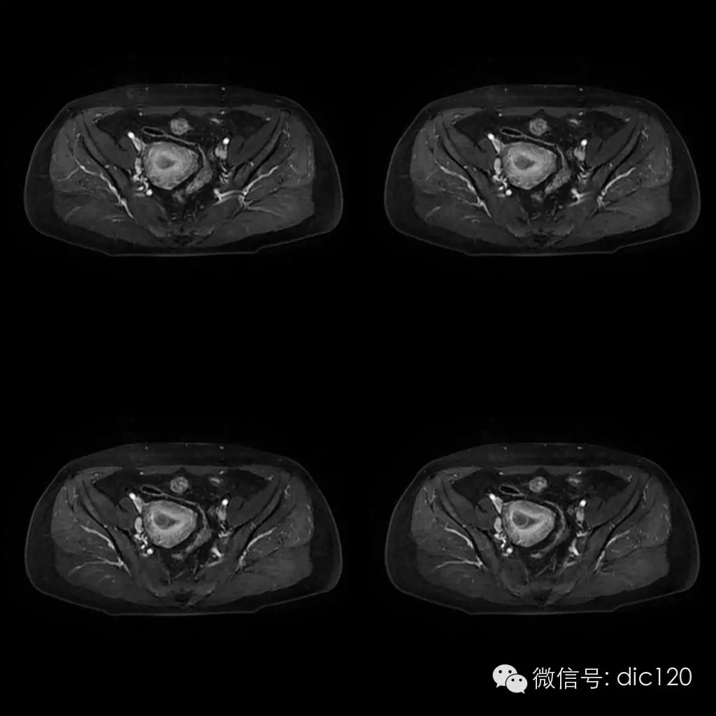 【病例学习】典型宫颈癌一例MR诊断与鉴别 【病例学习】典型宫颈癌一例MR诊断与鉴别