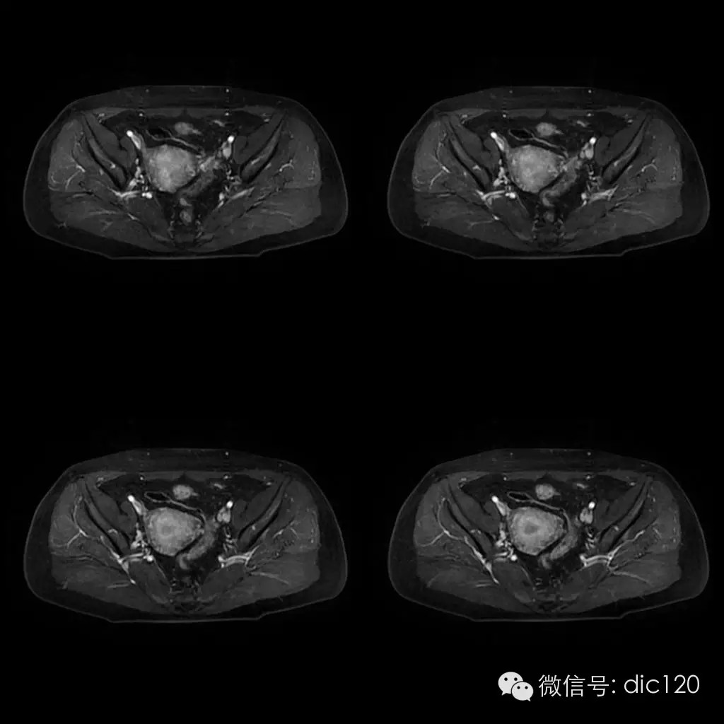 【病例学习】典型宫颈癌一例MR诊断与鉴别 【病例学习】典型宫颈癌一例MR诊断与鉴别