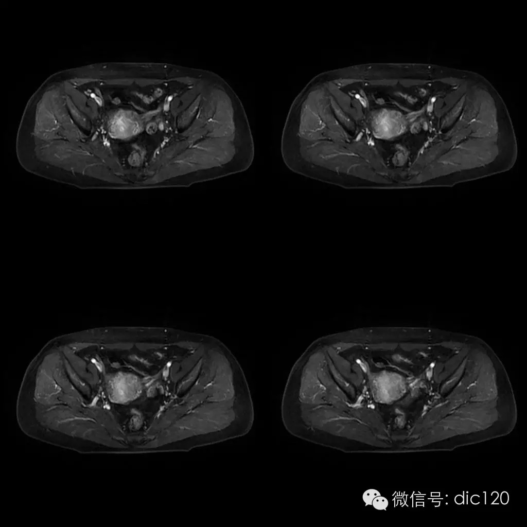 【病例学习】典型宫颈癌一例MR诊断与鉴别 【病例学习】典型宫颈癌一例MR诊断与鉴别