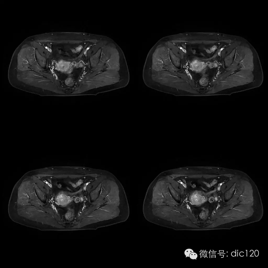 【病例学习】典型宫颈癌一例MR诊断与鉴别 【病例学习】典型宫颈癌一例MR诊断与鉴别