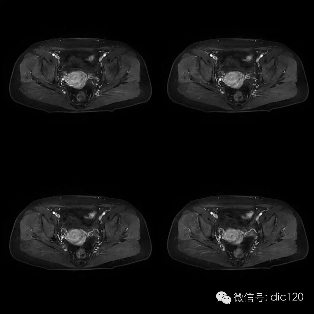 【病例学习】典型宫颈癌一例MR诊断与鉴别 【病例学习】典型宫颈癌一例MR诊断与鉴别