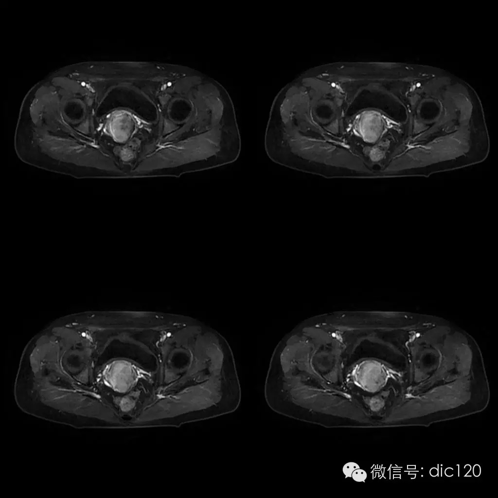 【病例学习】典型宫颈癌一例MR诊断与鉴别 【病例学习】典型宫颈癌一例MR诊断与鉴别