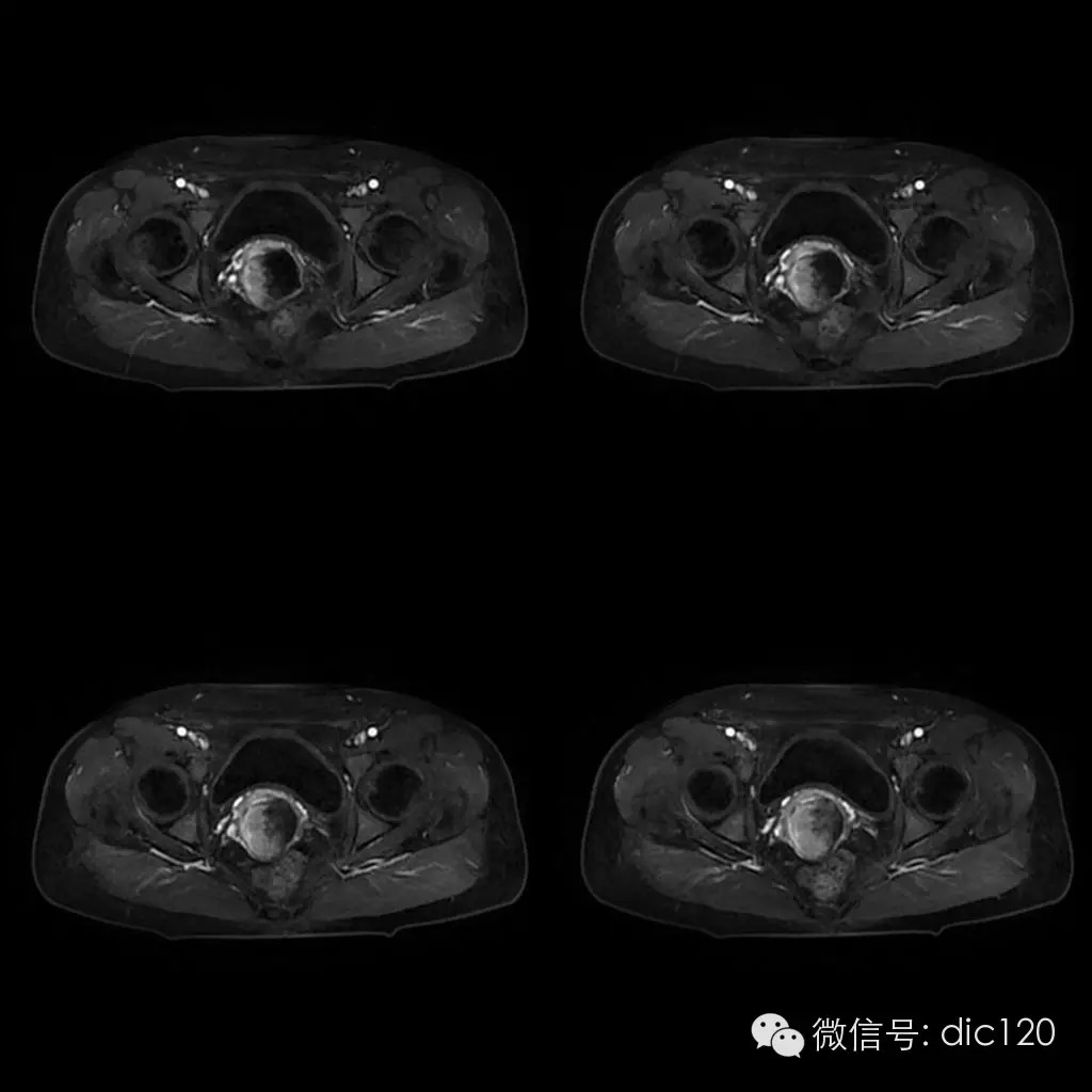 【病例学习】典型宫颈癌一例MR诊断与鉴别 【病例学习】典型宫颈癌一例MR诊断与鉴别