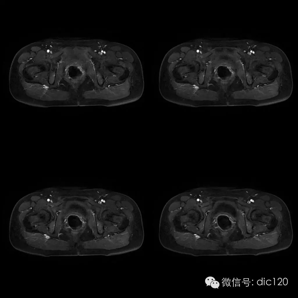 【病例学习】典型宫颈癌一例MR诊断与鉴别 【病例学习】典型宫颈癌一例MR诊断与鉴别