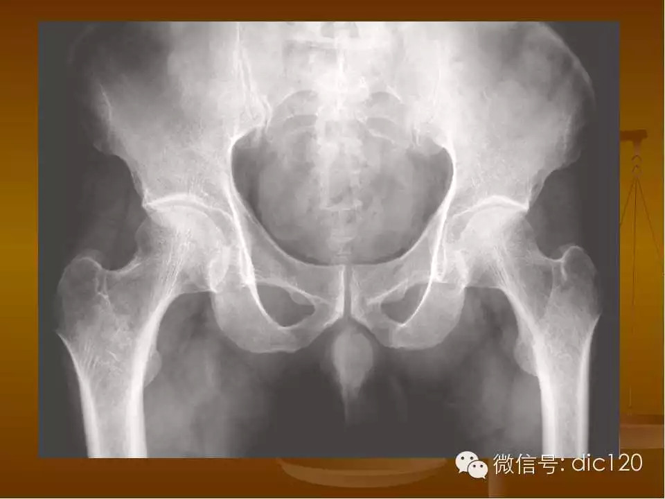 股骨头缺血坏死的影像学表现