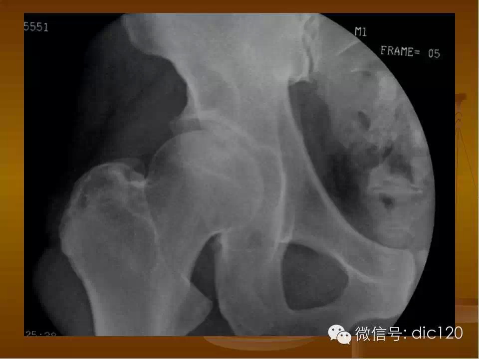 股骨头缺血坏死的影像学表现