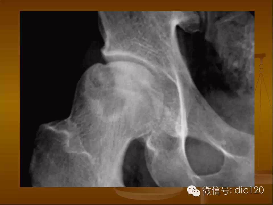 股骨头缺血坏死的影像学表现