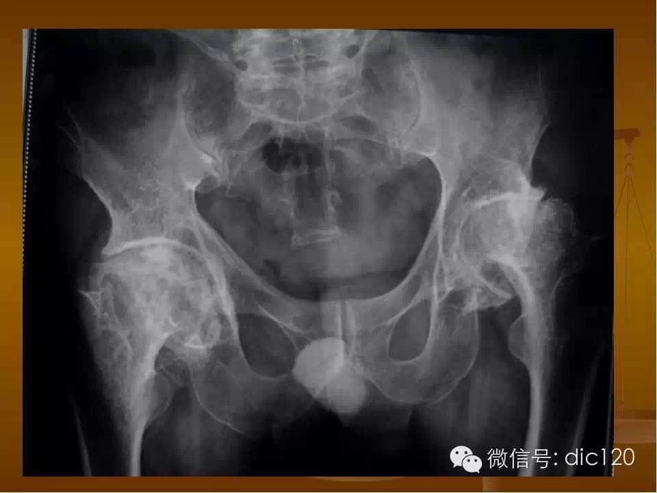 股骨头缺血坏死的影像学表现
