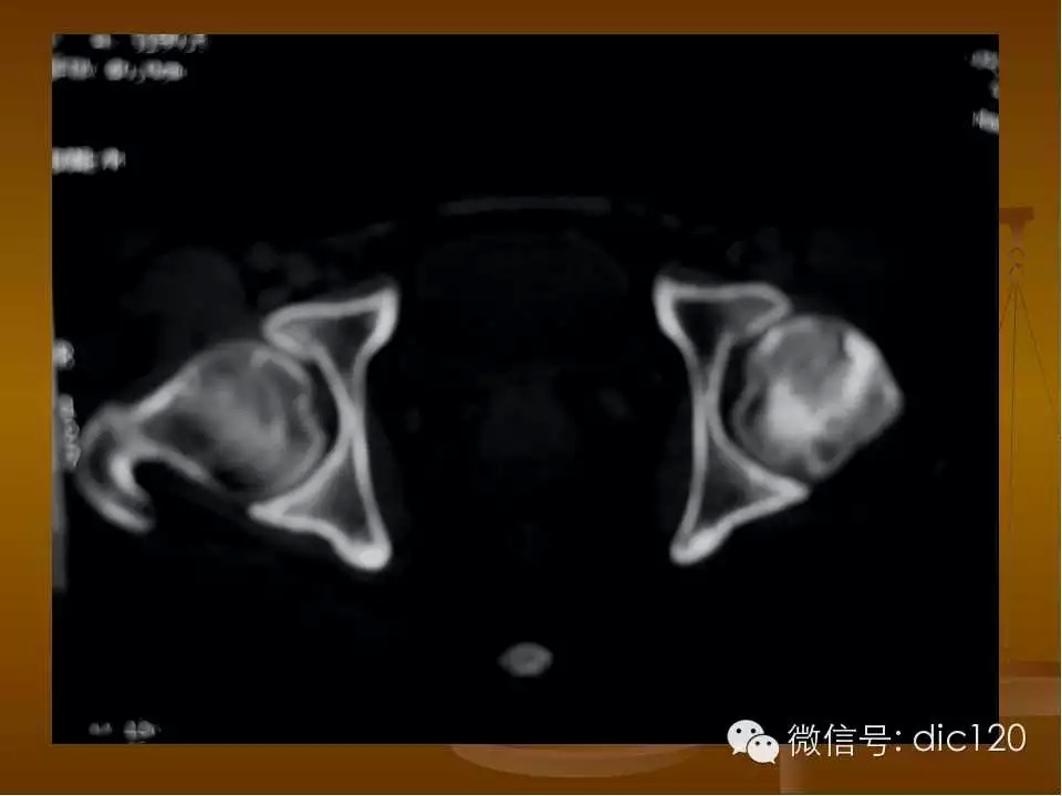 股骨头缺血坏死的影像学表现