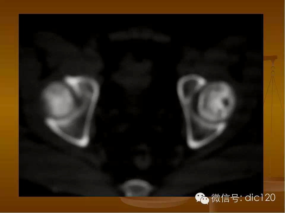 股骨头缺血坏死的影像学表现
