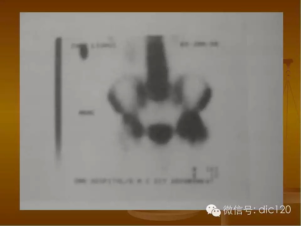 股骨头缺血坏死的影像学表现