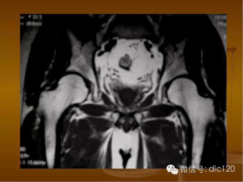 股骨头缺血坏死的影像学表现
