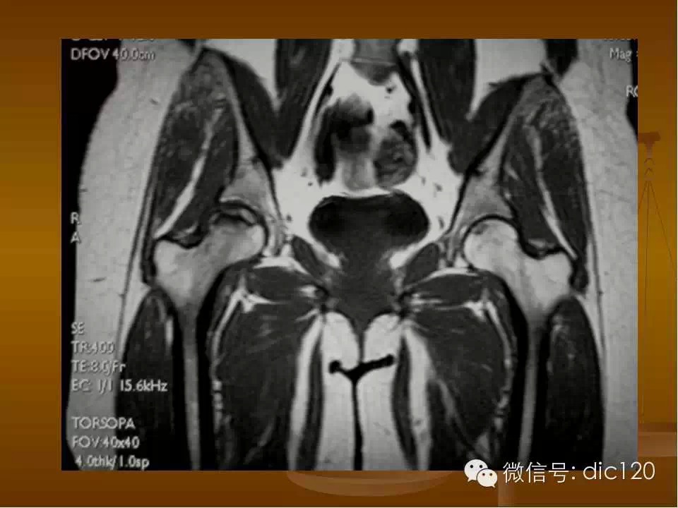 股骨头缺血坏死的影像学表现