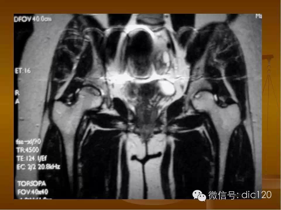 股骨头缺血坏死的影像学表现