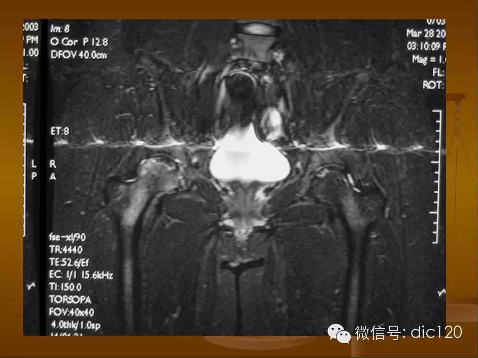 股骨头缺血坏死的影像学表现