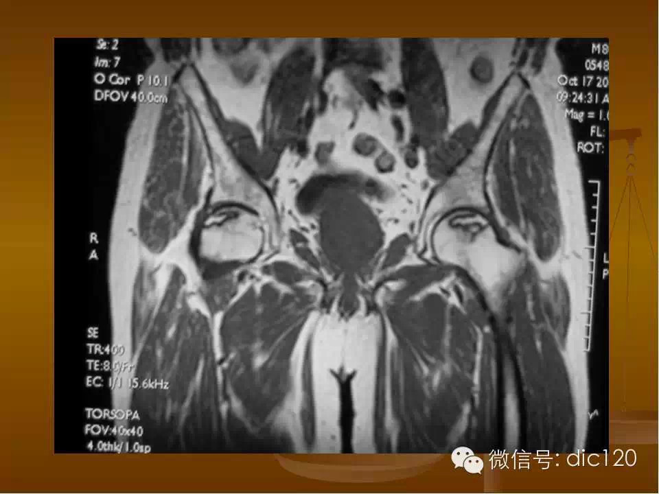 股骨头缺血坏死的影像学表现