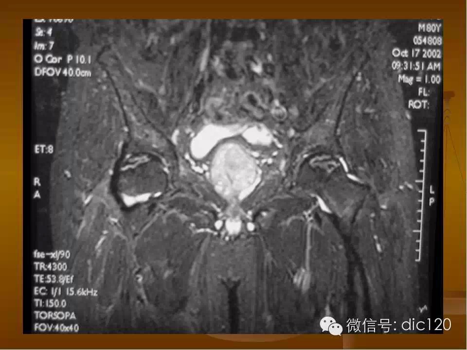 股骨头缺血坏死的影像学表现