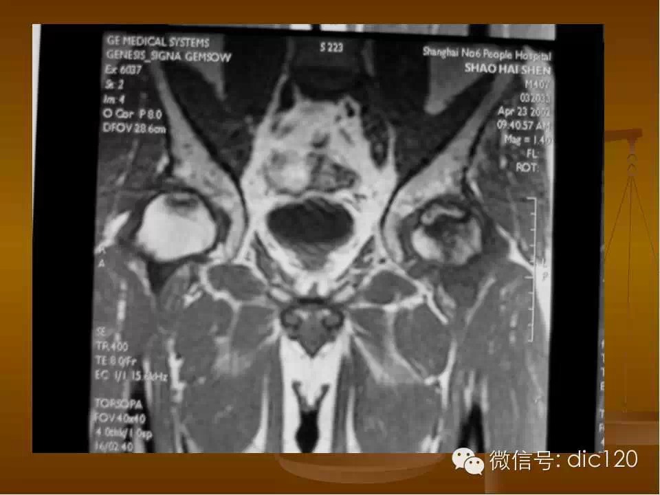 股骨头缺血坏死的影像学表现