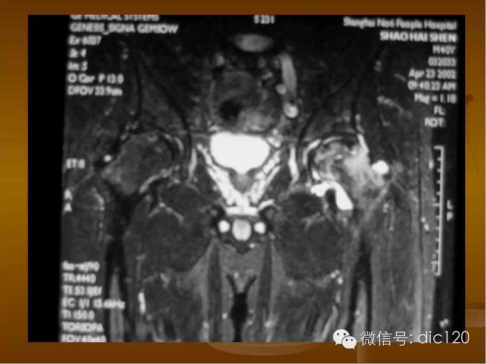 股骨头缺血坏死的影像学表现