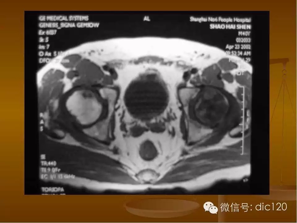 股骨头缺血坏死的影像学表现