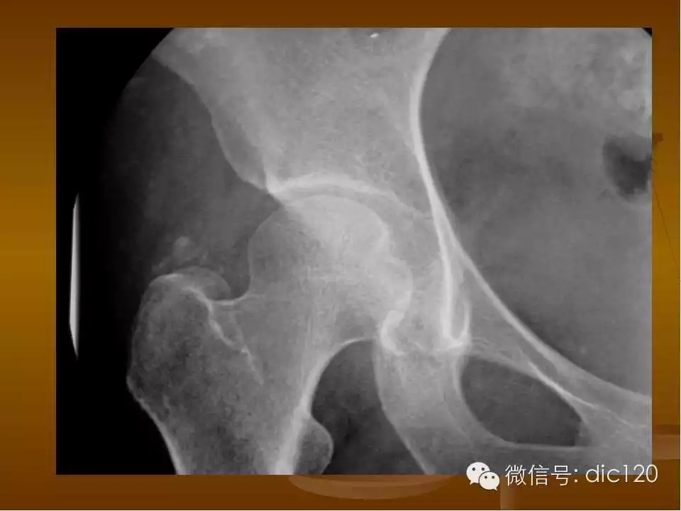 股骨头缺血坏死的影像学表现