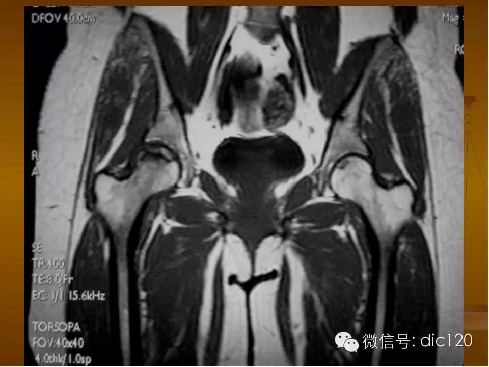 股骨头缺血坏死的影像学表现