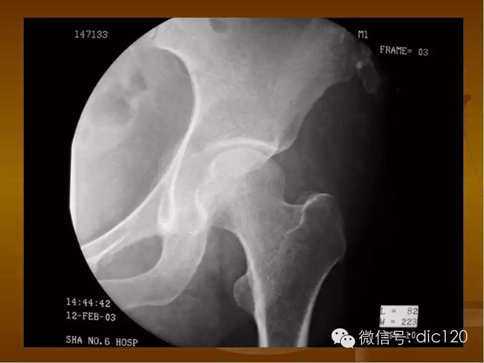 股骨头缺血坏死的影像学表现