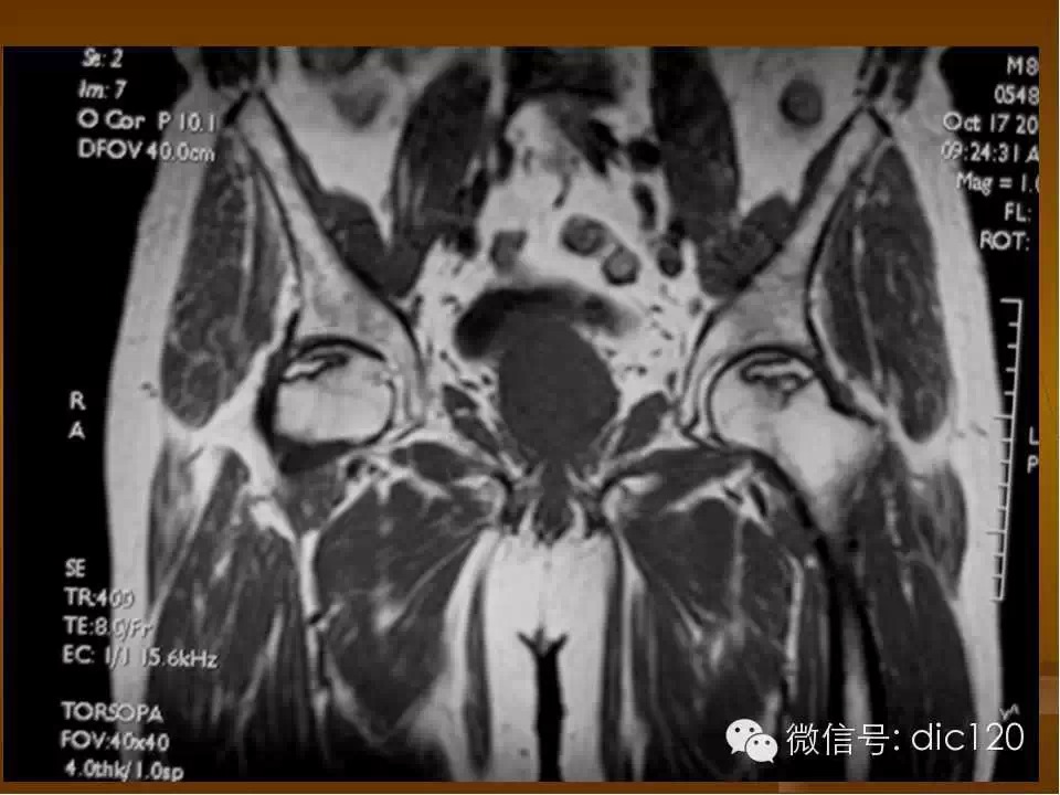 股骨头缺血坏死的影像学表现