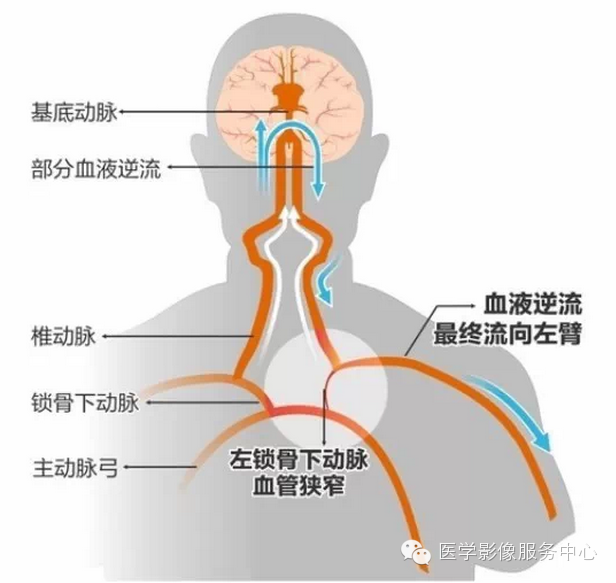 脑部盗血综合征