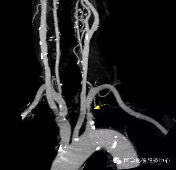 脑部盗血综合征 脑部盗血综合征