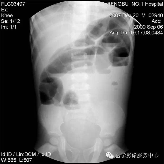 腹部X线摄影立位、仰卧位、侧卧位和斜位的临床意义