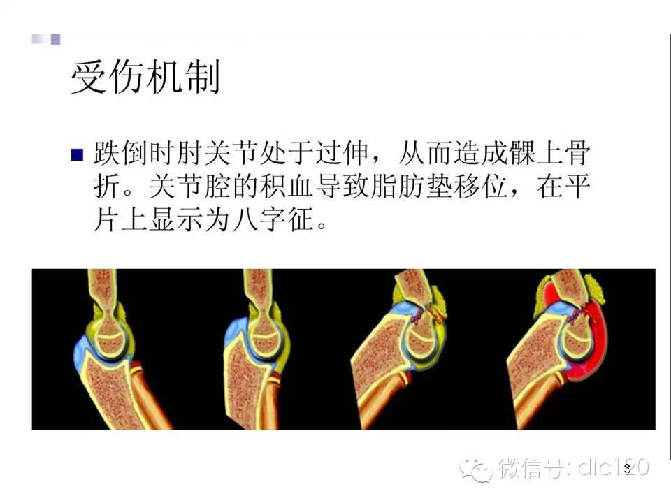 儿童肘关节骨折X线诊断