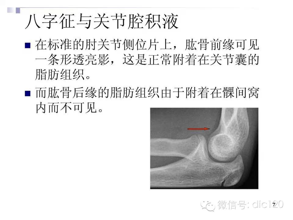 儿童肘关节骨折X线诊断