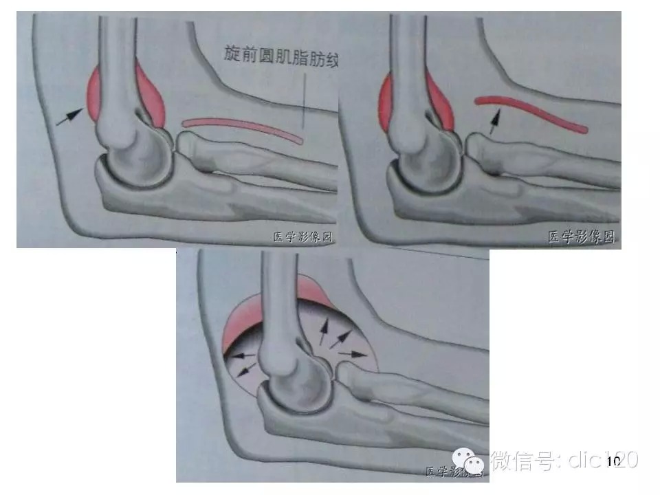 儿童肘关节骨折X线诊断